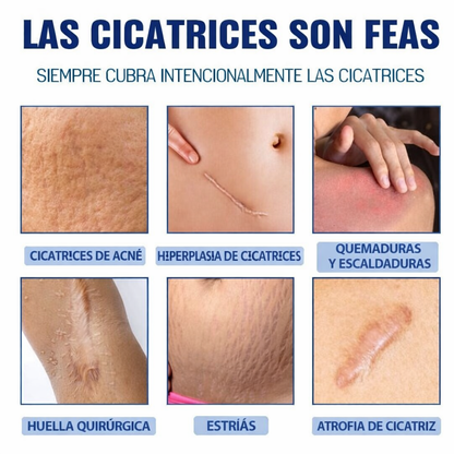 😣 DI ADIÓS A LAS MARCAS DE ACNÉ Recupera una piel suave y uniforme desde casa